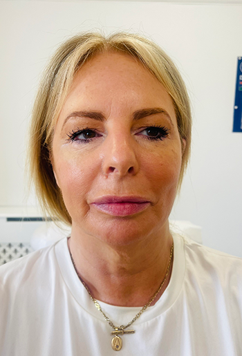 Dermal Filler Treatment in Liverpool