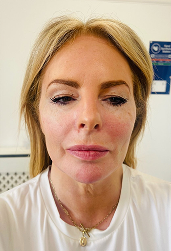 Dermal Filler Treatment in Liverpool