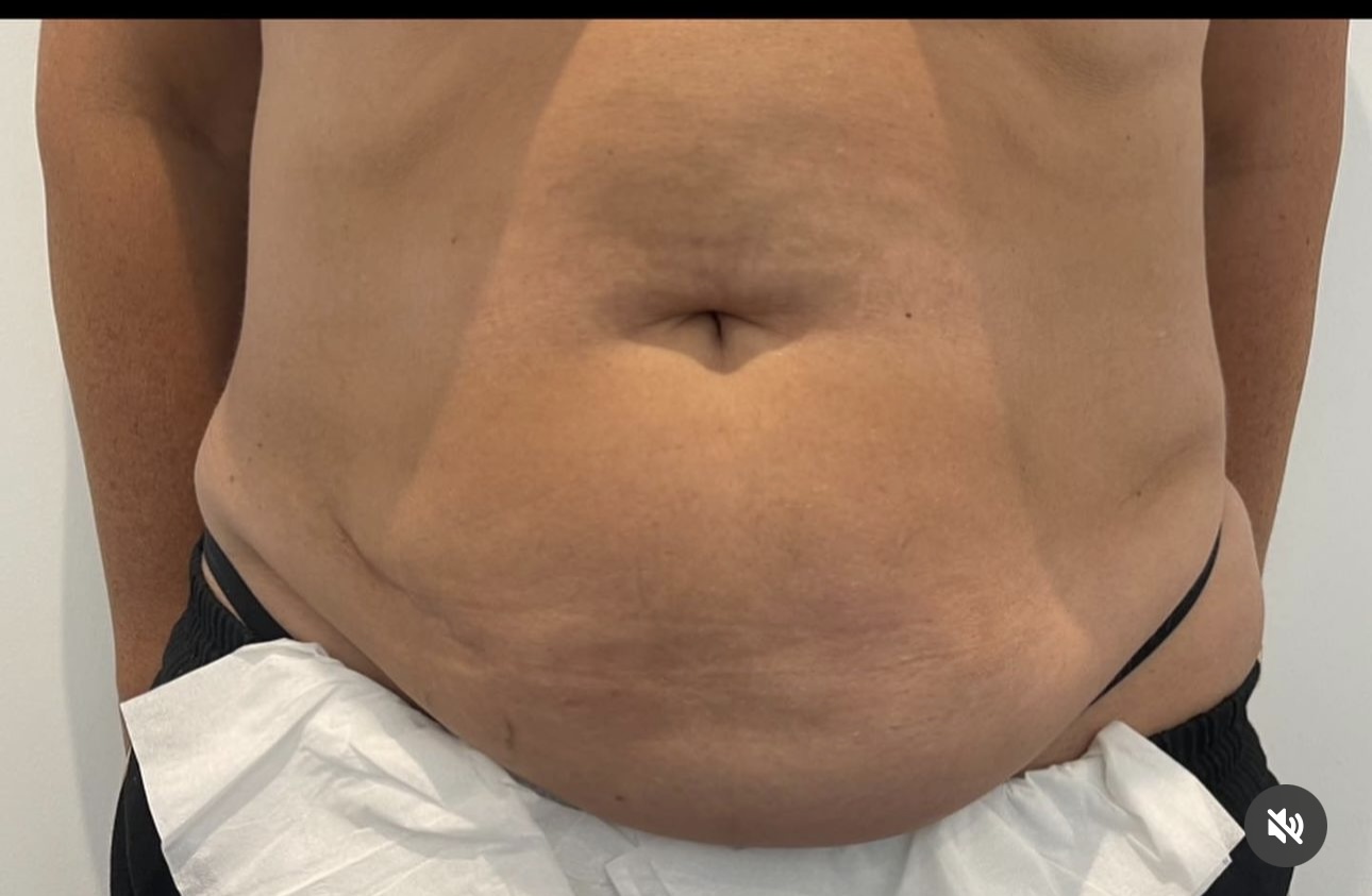 Fat Disolving Treatment in Liverpool