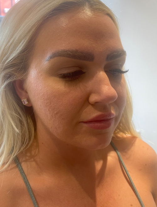 Mesotherapy Treatment in Liverpool