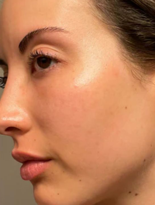 Microneedling Treatment in Liverpool