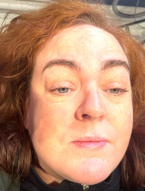 Mesotherapy Treatment in Liverpool