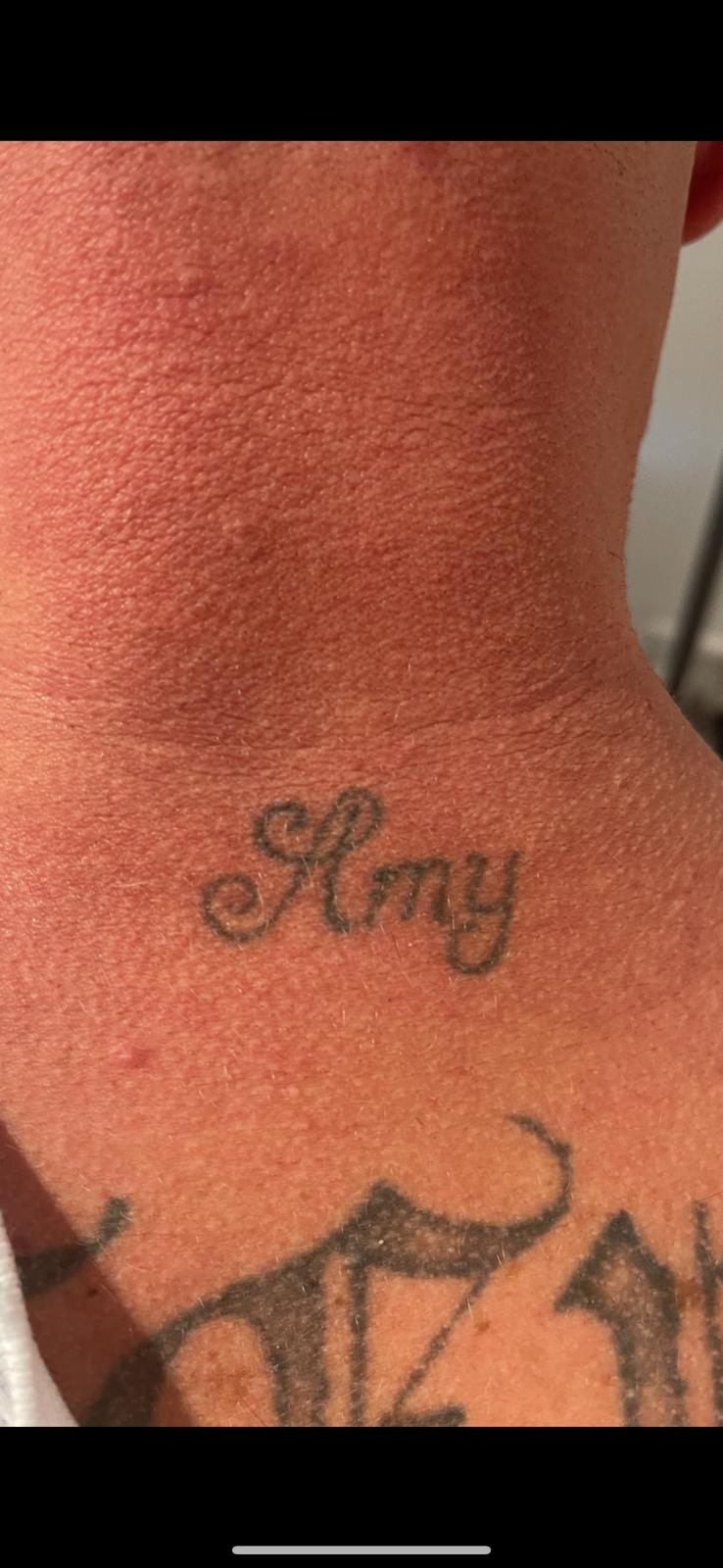 Laser Tattoo Removal in Liverpool